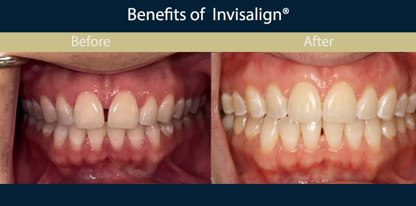 invisalign-dentist-nyc